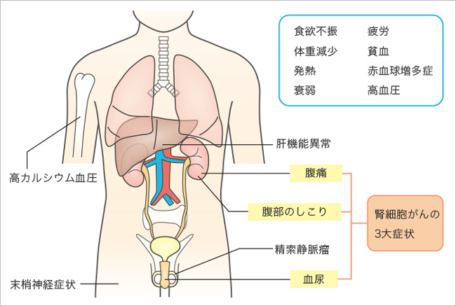 が 症状 腎臓 ん 腎臓のあたりが痛む