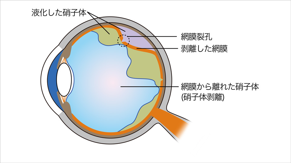 図2：裂孔原性網膜剥離のイメージ