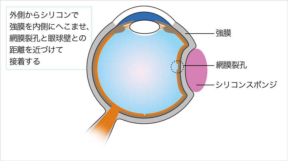 図3：強膜内陥術