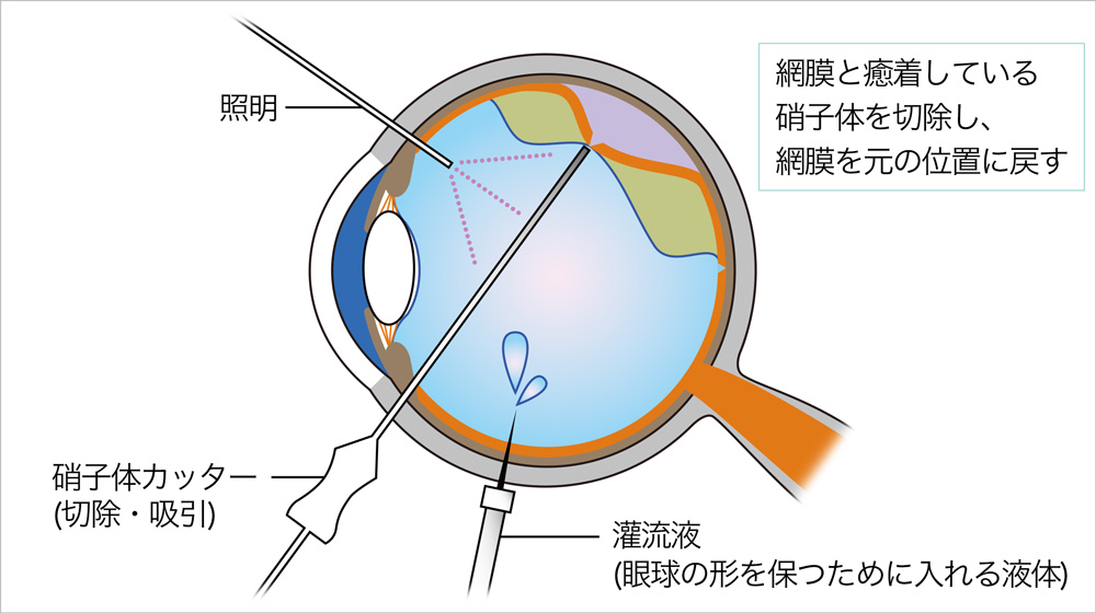 図4：硝子体切除術