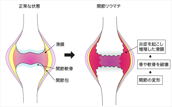 関節リウマチ