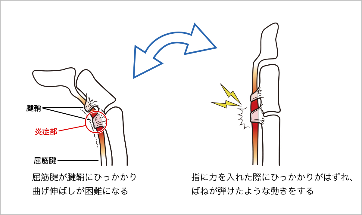 ばね指はこんな病気