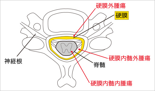 脊髄腫瘍の種類