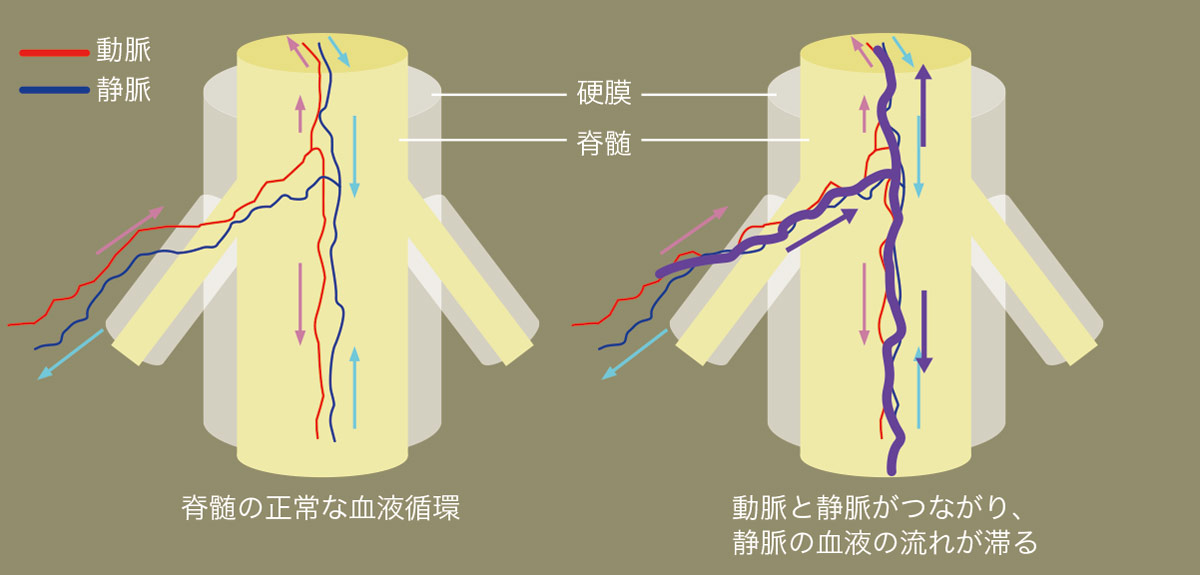 正常な血液循環との比較