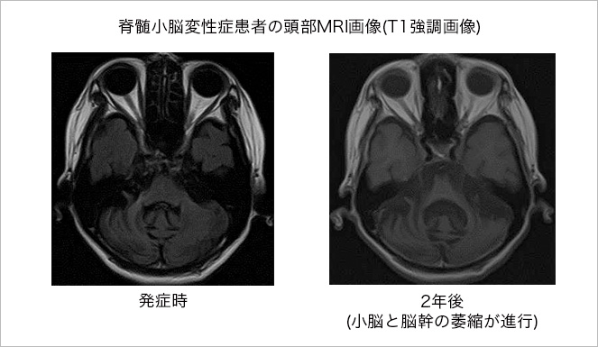 脊髄小脳変性症患者の頭部MRI画像(T1強調画像)