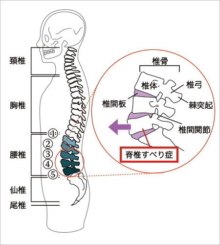 脊椎の構造と脊椎すべり症