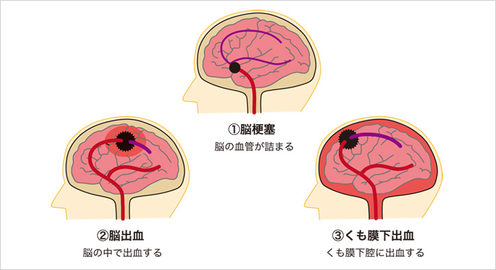 脳卒中から起こる失語症