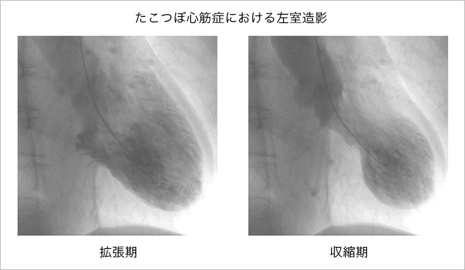 たこつぼ心筋症における左室造影