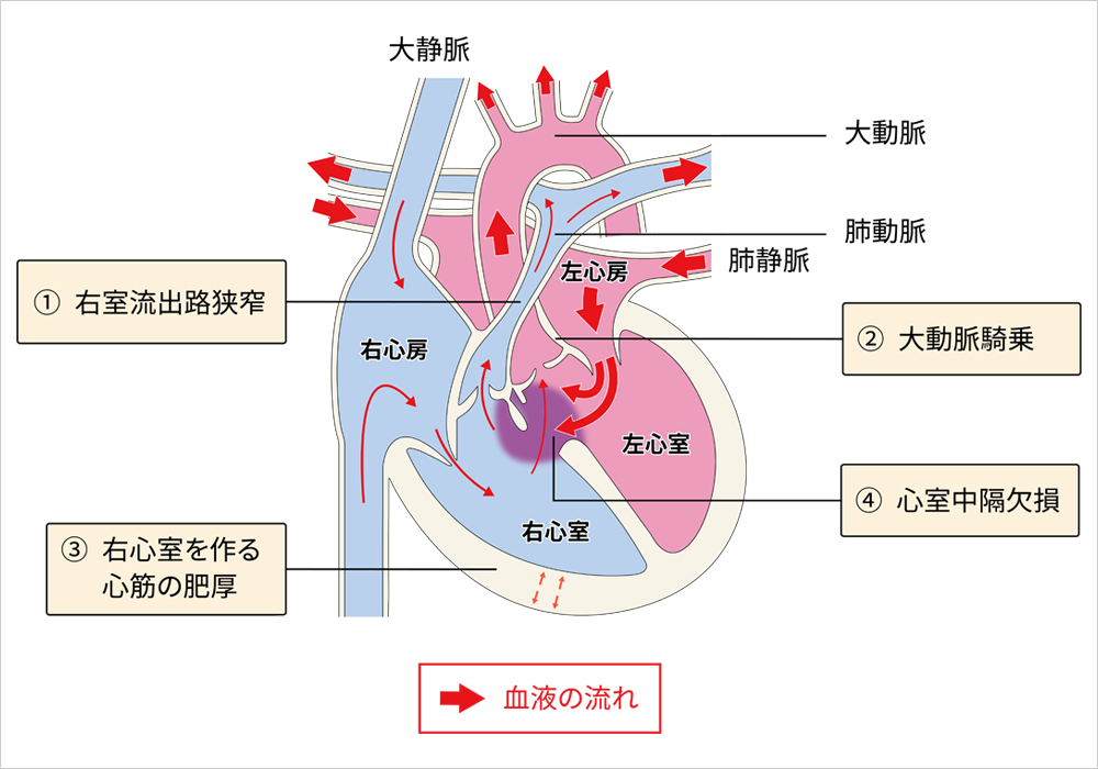 ファロー四徴症