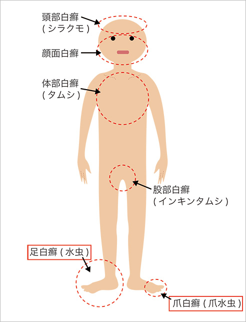 白癬菌の寄生部位別呼称