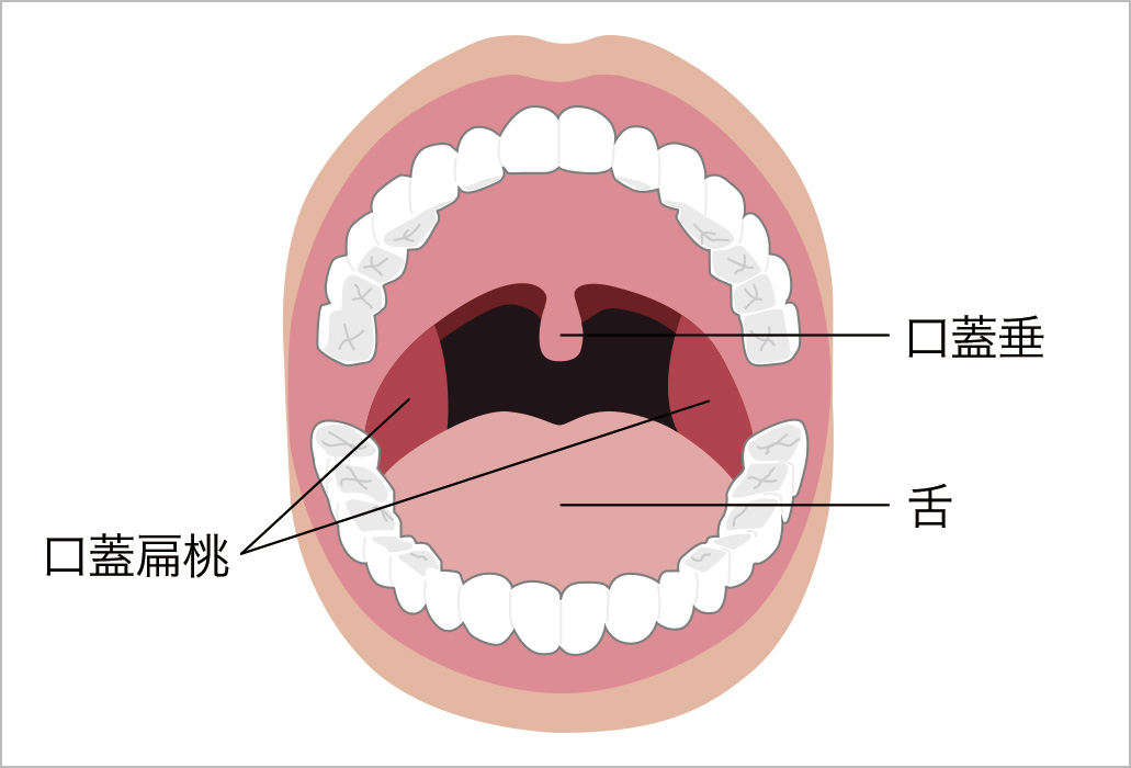 上 咽頭 炎 自然 に 治る