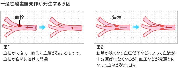 一過性脳虚血発作が発生する原因