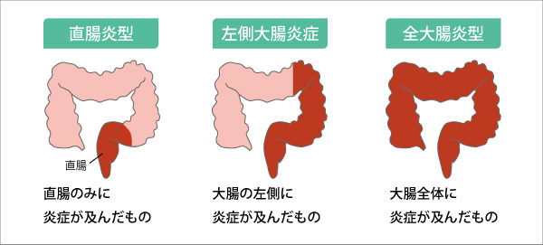 潰瘍性大腸炎の種類