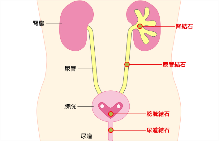 症状 結石