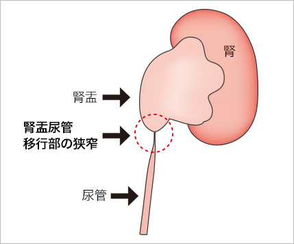 腎盂尿管移行部狭窄症