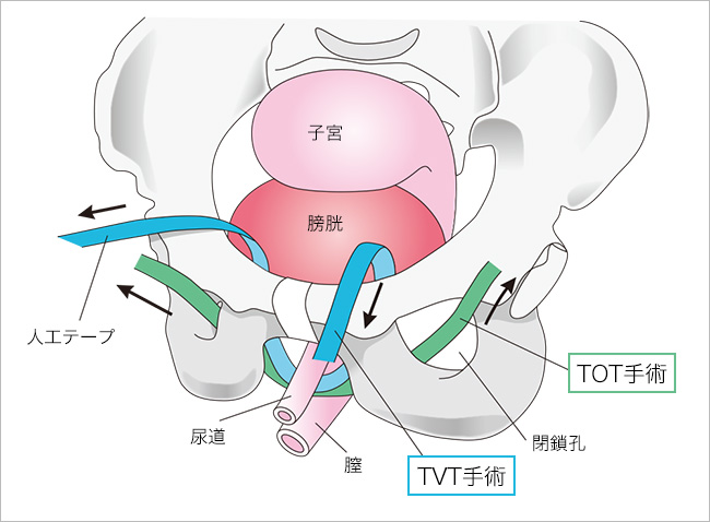 TVT手術とTOT手術