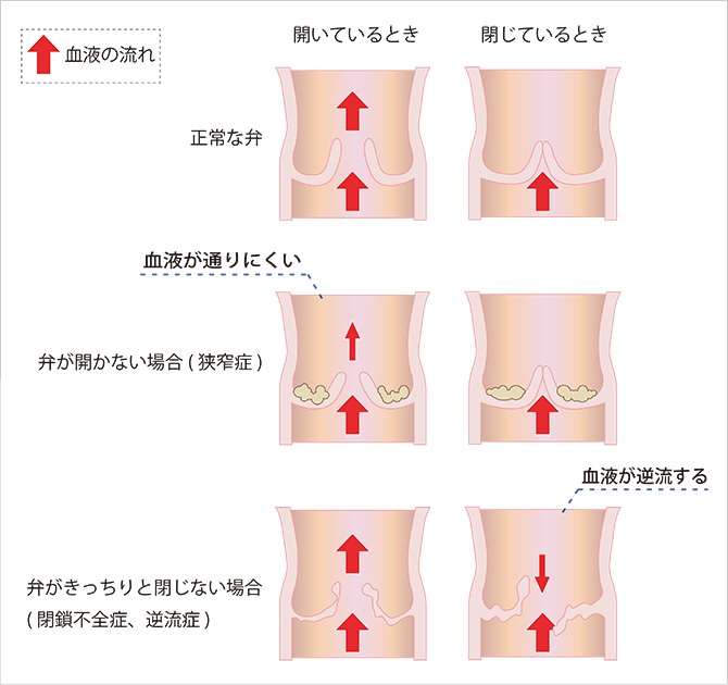 弁の機能異常