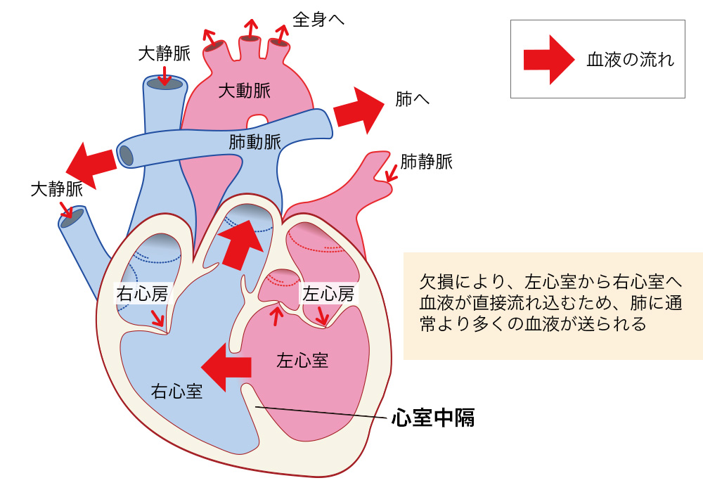 心室中隔欠損症 Vsd しんしつちゅうかくけっそんしょう 済生会