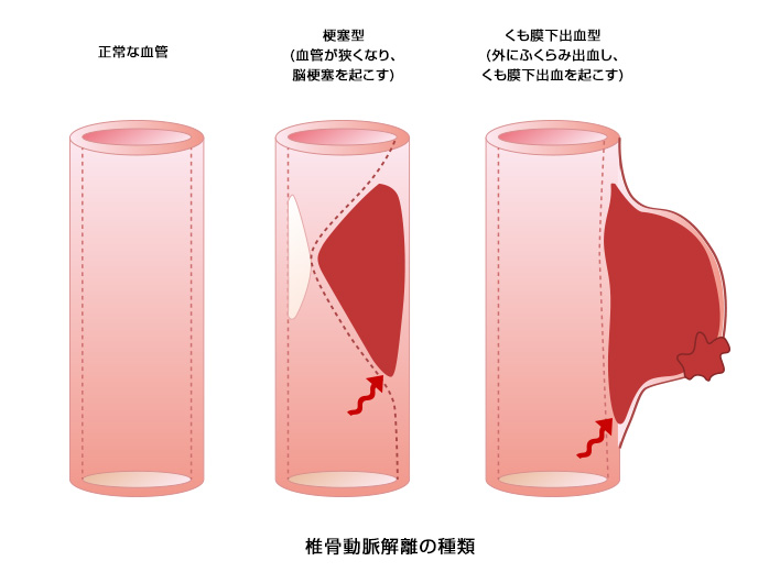 椎骨動脈解離の種類 