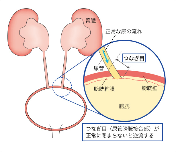 尿 管 内部 に は 逆流 防止 弁 が ある