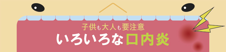 子供も大人も要注意 いろいろな口内炎