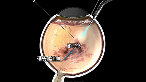 硝子体手術のイメージ