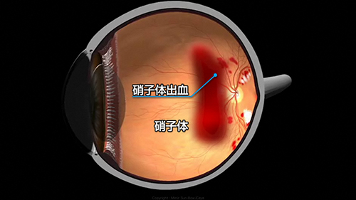 硝子体出血を発症した眼球