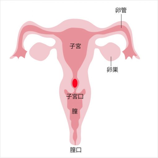 クラミジア性子宮頚管炎