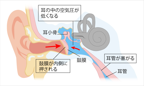 耳管狭窄症
