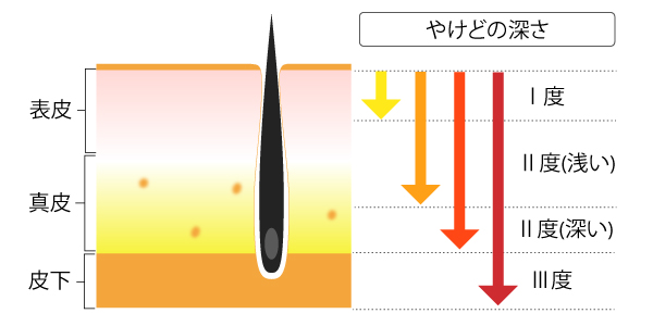 やけどの深さによる分類