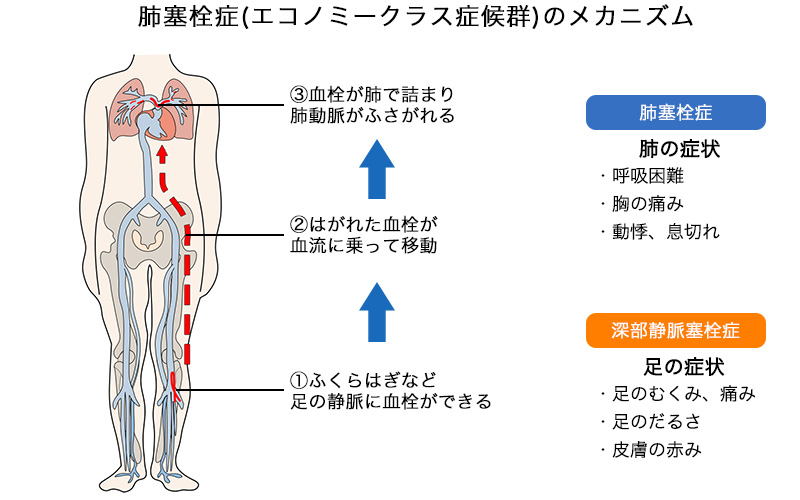 肺塞栓症(エコノミークラス症候群)のメカニズム