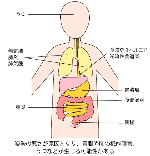 姿勢の悪化から肺機能の低下やうつに…