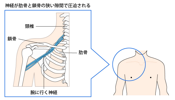 胸郭出口症候群-神経図