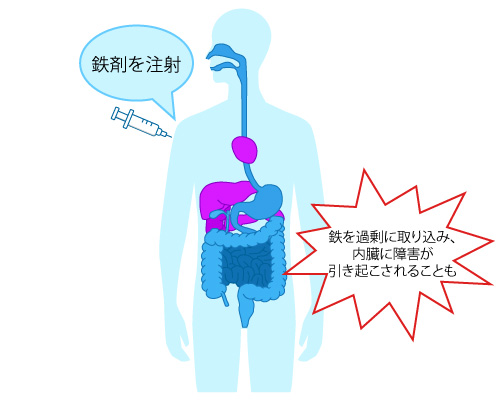 過剰な鉄剤摂取