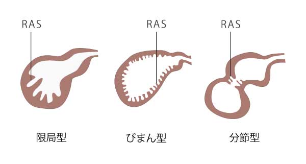 胆嚢腺筋腫症の人の今後の見通しはどうなりますか?