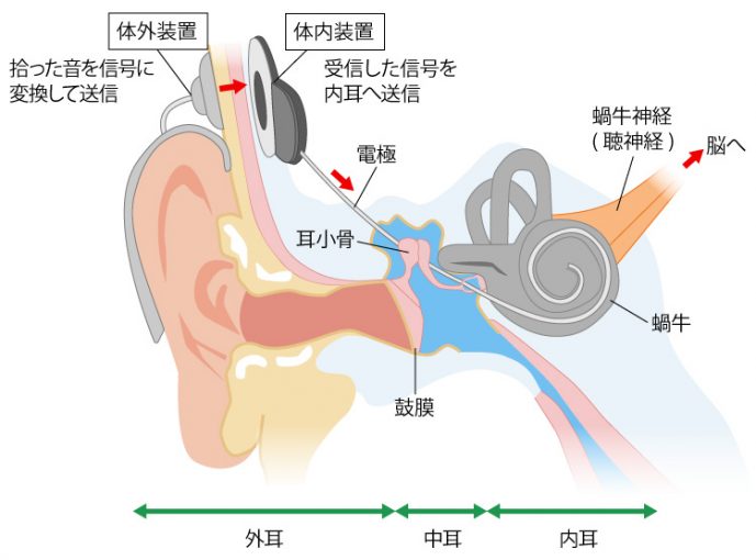 人工内耳のしくみ