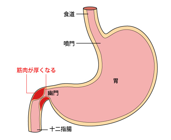 幽門狭窄の症状
