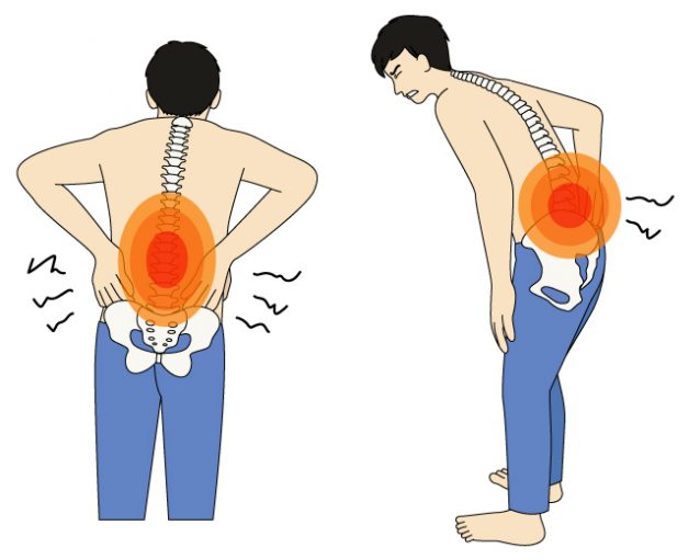 強直性脊椎炎 (きょうちょくせいせきついえん)とは | 済生会