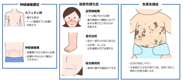 母斑症 (ぼはんしょう)とは | 済生会