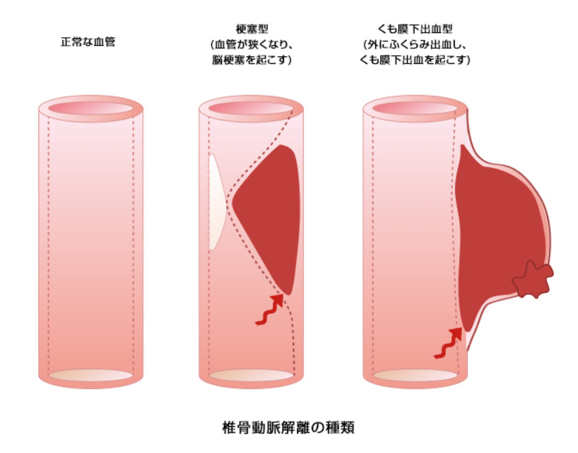 椎骨動脈解離 (ついこつどうみゃくかいり)とは | 済生会