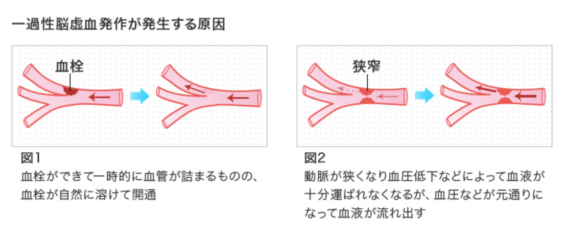 天然の血栓溶解酵素で血栓が溶けた! : 脳梗塞・心筋梗塞・血流障害からの生還者… 一過性脳虚血発作 (いっかせいのうきょけつほっさ)とは | 済生会