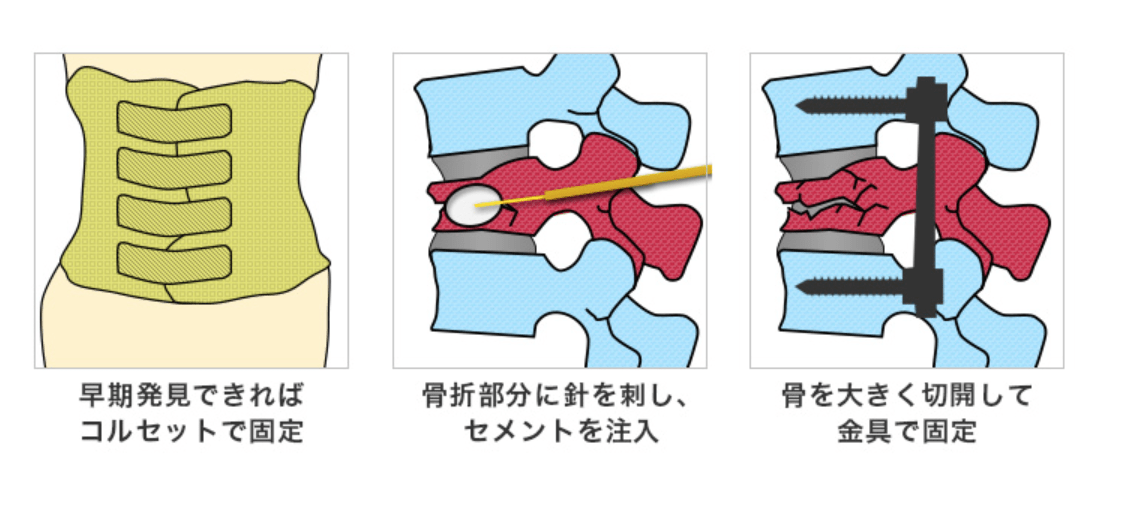 脊椎圧迫骨折 (せきついあっぱくこっせつ)とは | 済生会
